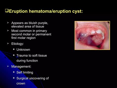 Eruption Hematoma Cyst