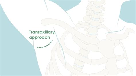 Image result for First Rib Resection Surgery