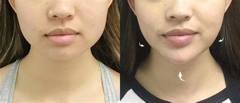 Image result for V-shape Face Exercise