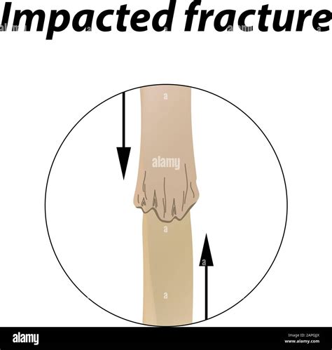 Impacted fracture Bone. Infographics. Vector illustration on a lined ...
