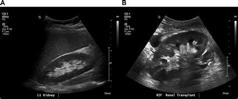 Kidney Ultrasound for Nephrologists: A Review - Kidney Medicine