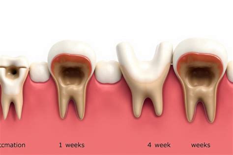 Image result for Pulled Tooth