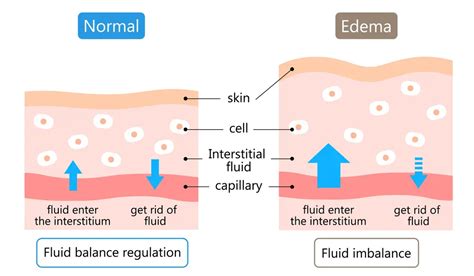 Cure Edema 的图像结果