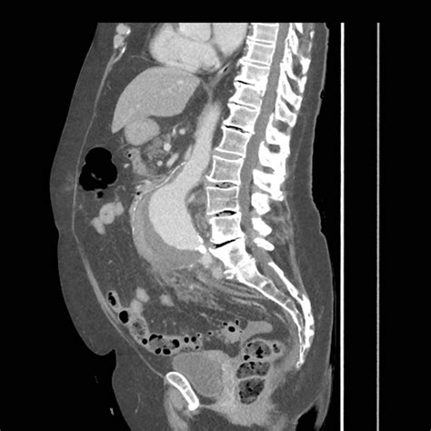 Caught on CT! The Case of the Hemodynamically Stable Ruptured Abdominal Aortic Aneurysm - JETem