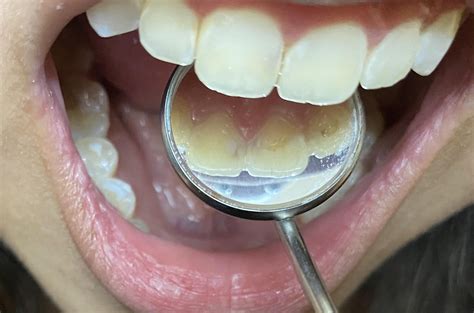 How will they fix my cavities? : r/askdentists