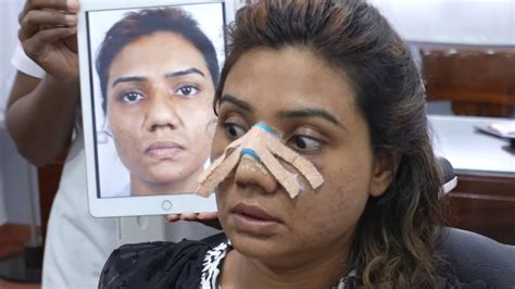 Splint Removal 的图像结果