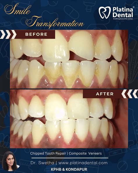 chipped tooth repair | Hyderabad Cosmetic Dentist | Dental Care in Hyderabad | Implants, Smile ...