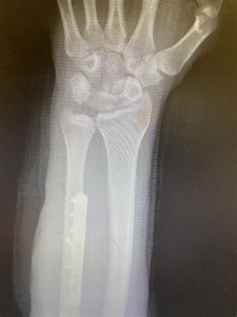 Ulnar Impaction Syndrome (UIS) | What is Ulnar Impaction Syndrome?