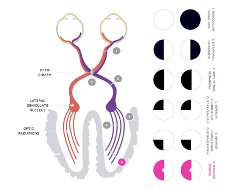 Visual Field Defects Classification - Oculab Blog