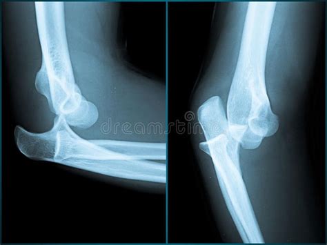 pneumonia x ray side view