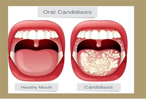 Oral Candidiasis: A Fungal Infection That Demands Attention - Your ...