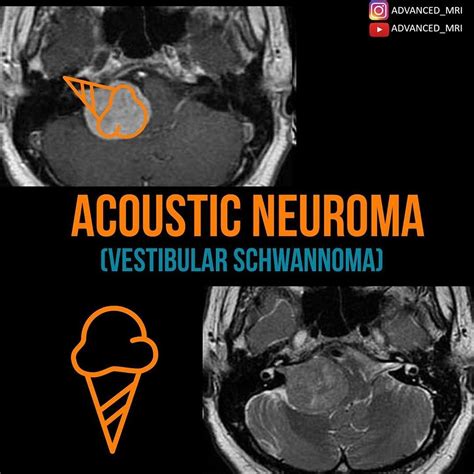 Cerebellopontine Angle Meningioma Presenting With Hearing Loss – ZHERSS