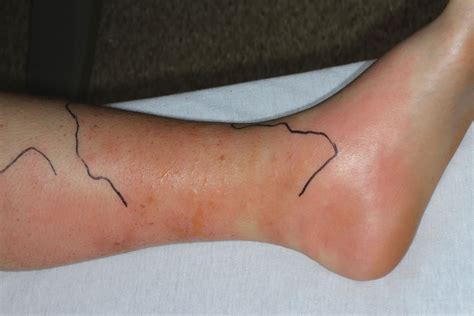 Summertime sighting: Painful swelling, erythema around the ankle