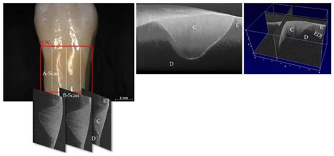 Dental Applications of Optical Coherence Tomography (OCT) in Cariology