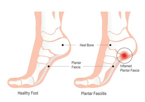 Will Plantar Fasciitis Go Away