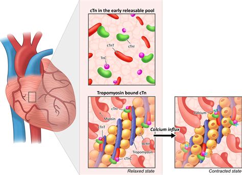 Heart Enzymes Elevated Troponin at Kayla Chirnside blog