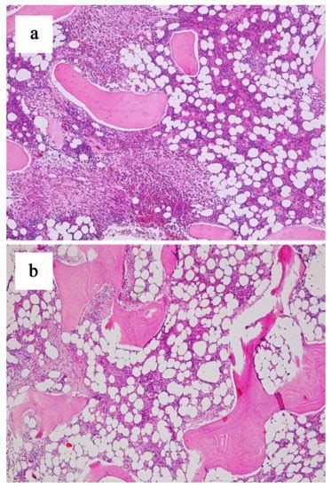 Real-World Efficacy of Midostaurin in Aggressive Systemic Mastocytosis