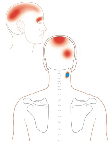 Trigger Point Therapy - Splenius Capitis/Splenius Cervicis | Niel Asher ...