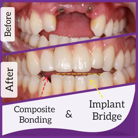 Orthodontic Bonding Protocol at Xavier Guerard blog