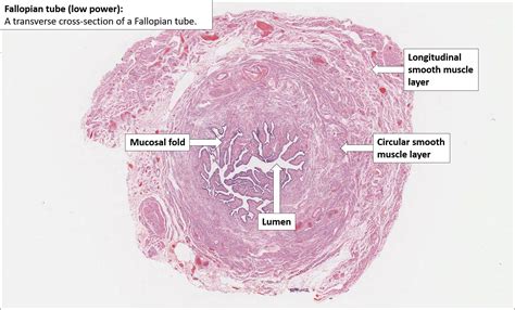 Histologia De Cisto De Trompa De Falopio