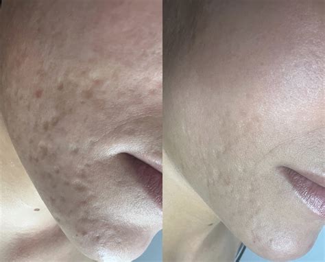 CO2 Laser Resurfacing - The Norwich Face & Body Clinic
