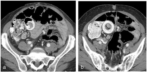 Imaging of Meckel's diverticulum in adults: pictorial essay - Clinical Imaging