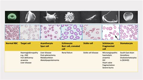 Red Cells: Counts and Interpretation – Blood & Water