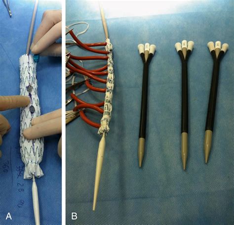 Fenestrated and Branched Endograft Treatment of Juxtarenal, Paravisceral, Thoracoabdominal, and ...