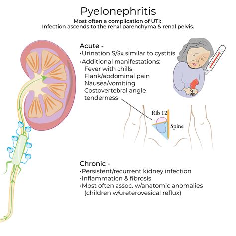 Clinical Pathology Glossary: Pyelonephritis | ditki medical ...