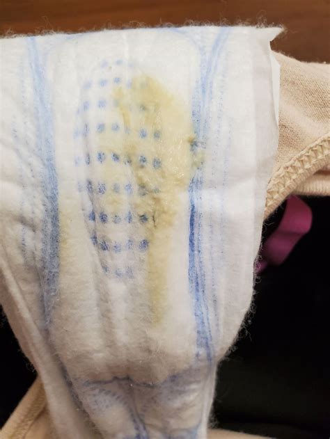 Clumpy Discharge 的图像结果