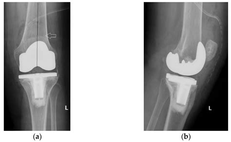 Patellar Resurfacing in Total Knee Arthroplasty, a Never-Ending Controversy; Case Report and ...