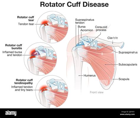 Rotator Cuff Pain
