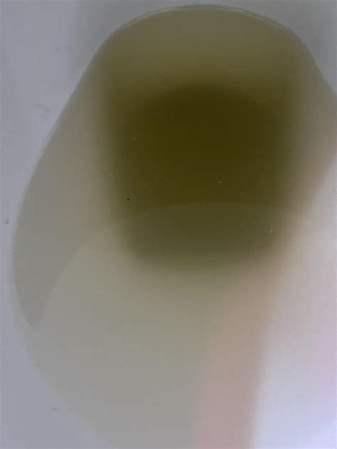Just peed this out. What is it??? Cloudy, particles in urine please doctors can’t figure it out ...