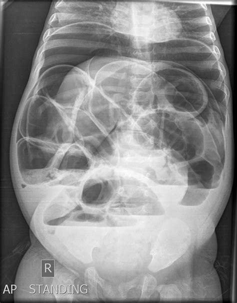 Perforated bowel, causes, symptoms, diagnosis, treatment & prognosis