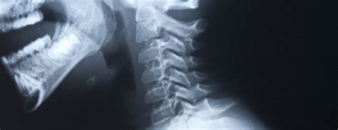 Image result for Neck X-Ray