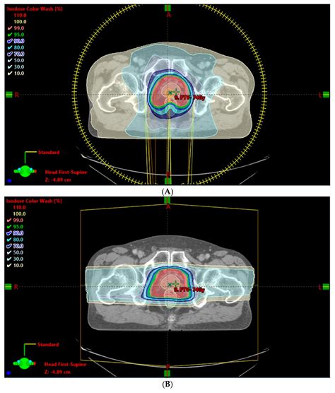 What Is Proton Beam Therapy For Prostate Cancer Research - The Best Picture Of Beam