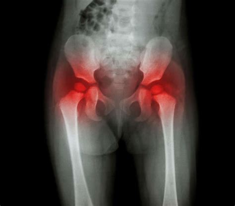 Understanding Hip Fractures: Causes, Risks, and Recovery - Charlottesville Orthopaedic Center