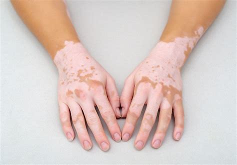 VITILIGO - Dr. Sandip Agrawal