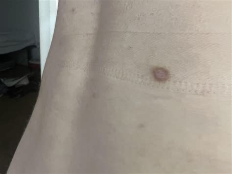 Painful round bump on lower back! : r/DermatologyQuestions