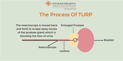 Image result for Turp Procedure Explained