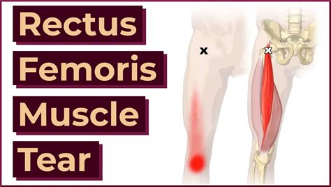 Rectus Femoris Muscle Tear - MedEd Cases