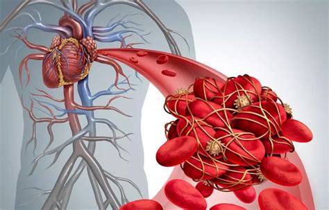 Elevated homocysteine positively associated with plasma TG and remnant ...