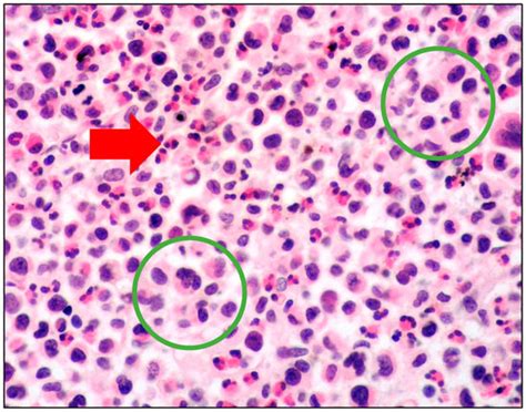 Mast Cell Leukemia: An Update with a Practical Review