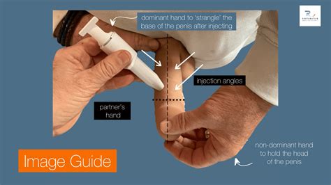Image result for Trimix Injection Demonstration