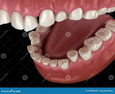Dental Attrition Bruxism Resulting in Loss of Tooth Tissue. Medically ...