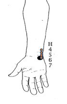 8. Sudden Loss of Voice. Massage points H 4, 5, 6 and 7. The points are ...