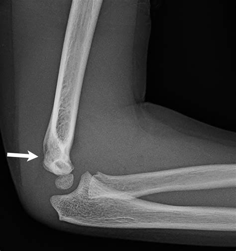 Epicondyle Fracture X Ray at Mary Ranney blog