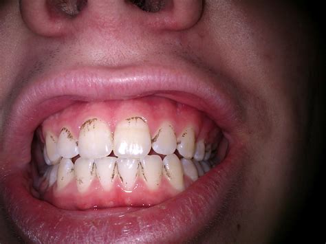 Black spots on teeth - Chromogenic bacteria? : r/Dentistry