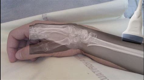 Image result for Open Reduction Distal Radius Fracture