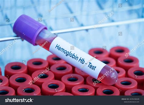 Blood Analysis Hb at Johnnie Allison blog